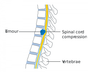 Nerve Compression