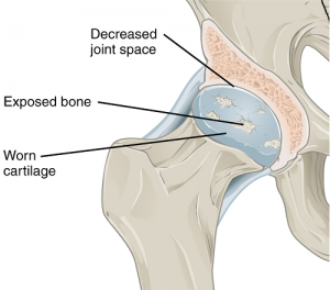 Osteoarthritis